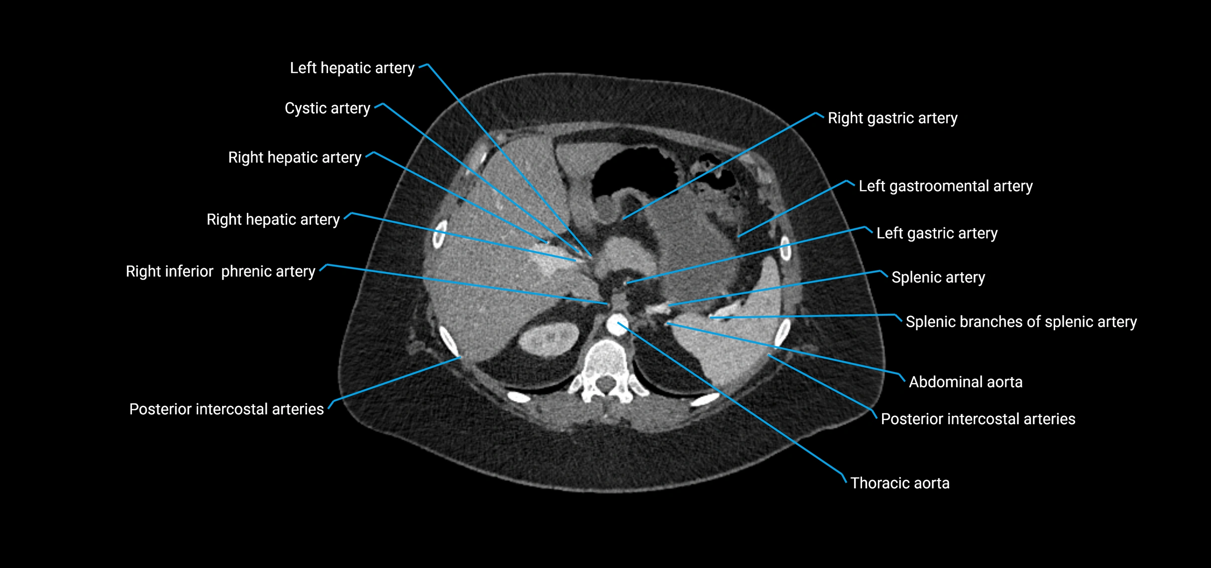 CTA abdomen axial cross sectional anatomy labelled image_44 (2).webp